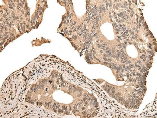 Immunohistochemistry of paraffin-embedded Human colorectal cancer tissue using ZSCAN12 Polyclonal Antibody at dilution of 1:50(×200)