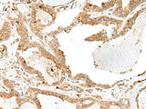 Immunohistochemistry of paraffin-embedded Human thyroid cancer tissue using ENAH Polyclonal Antibody at dilution of 1:60(×200)
