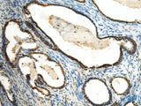 Immunohistochemistry of paraffin-embedded Human prost at e cancer tissue using SUV39H2 Polyclonal Antibody at dilution of 1:70(×200)