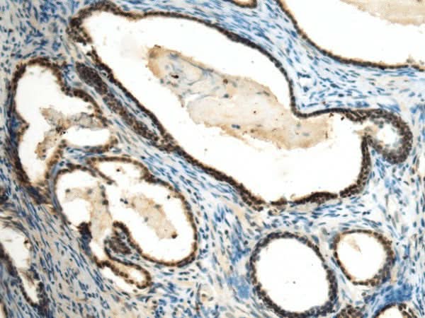 Immunohistochemistry of paraffin-embedded Human prost at e cancer tissue using SUV39H2 Polyclonal Antibody at dilution of 1:70(×200)