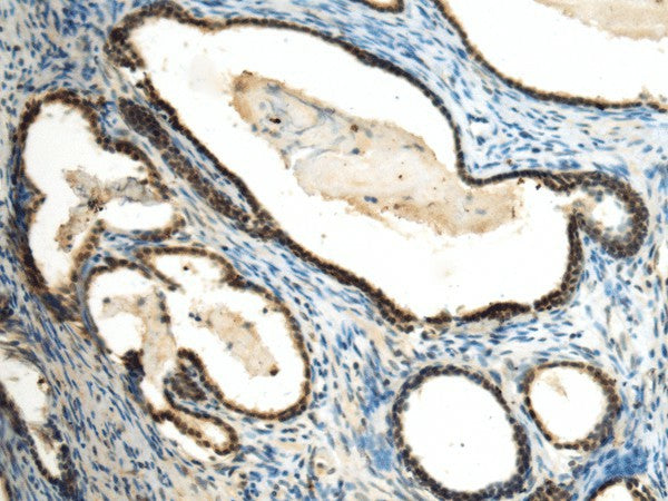 Immunohistochemistry of paraffin-embedded Human prost at e cancer tissue using SUV39H2 Polyclonal Antibody at dilution of 1:70(×200)