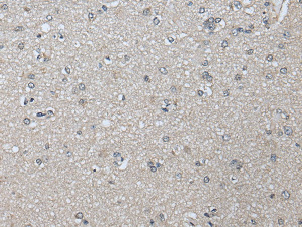 Immunohistochemistry of paraffin-embedded Human brain tissue using PRAME Polyclonal Antibody at dilution of 1:65(×200)