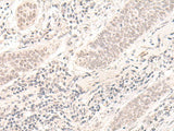 Immunohistochemistry of paraffin-embedded Human esophagus cancer tissue using ZBED1 Polyclonal Antibody at dilution of 1:40(×200)