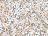 Immunohistochemistry of paraffin-embedded Human liver cancer tissue using NFKB1 Polyclonal Antibody at dilution of 1:50(×200)