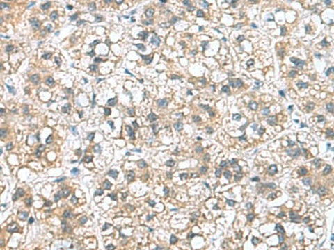 Immunohistochemistry of paraffin-embedded Human liver cancer tissue using NFKB1 Polyclonal Antibody at dilution of 1:50(×200)
