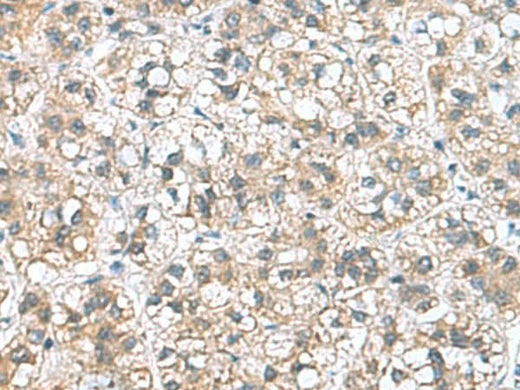 Immunohistochemistry of paraffin-embedded Human liver cancer tissue using NFKB1 Polyclonal Antibody at dilution of 1:50(×200)