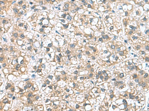 Immunohistochemistry of paraffin-embedded Human liver cancer tissue using NFKB1 Polyclonal Antibody at dilution of 1:50(×200)