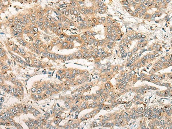 Immunohistochemistry of paraffin-embedded Human liver cancer tissue using CPNE4 Polyclonal Antibody at dilution of 1:40(×200)