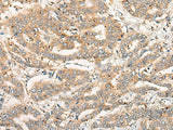 Immunohistochemistry of paraffin-embedded Human liver cancer tissue using CPNE4 Polyclonal Antibody at dilution of 1:40(×200)