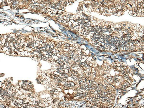 Immunohistochemistry of paraffin-embedded Human gastric cancer tissue using CALHM1 Polyclonal Antibody at dilution of 1:40(×200)