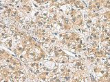 Immunohistochemistry of paraffin-embedded Human liver cancer tissue using PPIH Polyclonal Antibody at dilution of 1:70(×200)