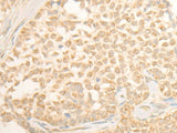 Immunohistochemistry of paraffin-embedded Human ovarian cancer tissue using CYP4X1 Polyclonal Antibody at dilution of 1:40(×200)