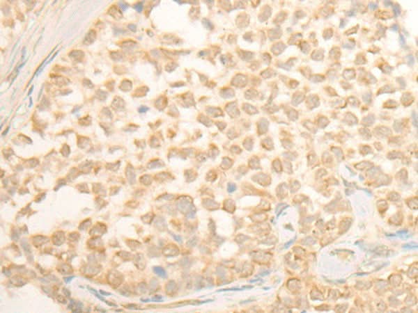 Immunohistochemistry of paraffin-embedded Human ovarian cancer tissue using CYP4X1 Polyclonal Antibody at dilution of 1:40(×200)