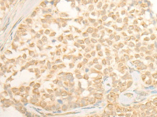 Immunohistochemistry of paraffin-embedded Human ovarian cancer tissue using CYP4X1 Polyclonal Antibody at dilution of 1:40(×200)