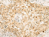 Immunohistochemistry of paraffin-embedded Human esophagus cancer tissue using EXOSC4 Polyclonal Antibody at dilution of 1:70(×200)