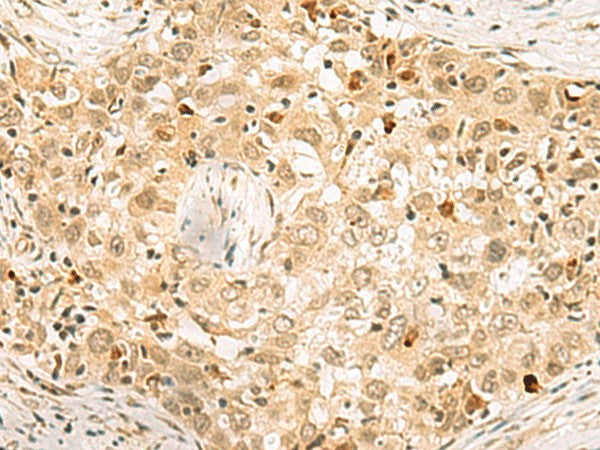 Immunohistochemistry of paraffin-embedded Human esophagus cancer tissue using EXOSC4 Polyclonal Antibody at dilution of 1:70(×200)
