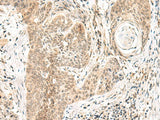 Immunohistochemistry of paraffin-embedded Human esophagus cancer tissue using GPSM1 Polyclonal Antibody at dilution of 1:55(×200)