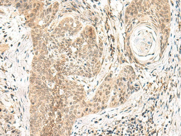 Immunohistochemistry of paraffin-embedded Human esophagus cancer tissue using GPSM1 Polyclonal Antibody at dilution of 1:55(×200)