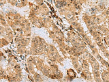 Immunohistochemistry of paraffin-embedded Human thyroid cancer tissue using ASNA1 Polyclonal Antibody at dilution of 1:70(×200)