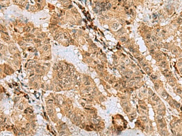Immunohistochemistry of paraffin-embedded Human thyroid cancer tissue using ASNA1 Polyclonal Antibody at dilution of 1:70(×200)