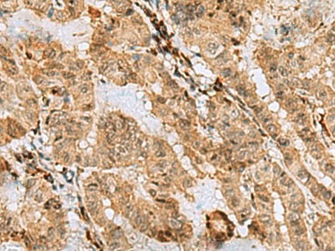 Immunohistochemistry of paraffin-embedded Human thyroid cancer tissue using ASNA1 Polyclonal Antibody at dilution of 1:70(×200)