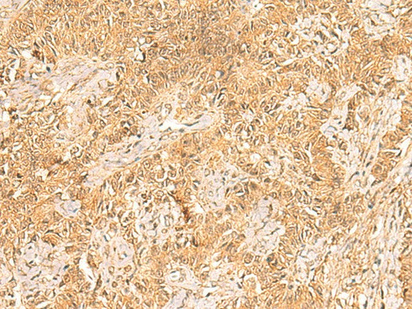 Immunohistochemistry of paraffin-embedded Human ovarian cancer tissue using TRMT112 Polyclonal Antibody at dilution of 1:30(×200)