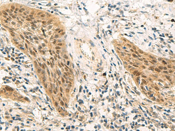 Immunohistochemistry of paraffin-embedded Human esophagus cancer tissue using PSME1 Polyclonal Antibody at dilution of 1:50(×200)