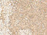 Immunohistochemistry of paraffin-embedded Human ovarian cancer tissue using FBXL4 Polyclonal Antibody at dilution of 1:25(×200)