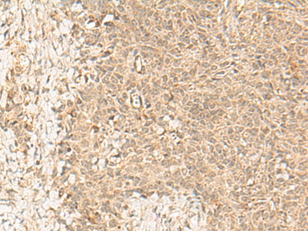 Immunohistochemistry of paraffin-embedded Human ovarian cancer tissue using FBXL4 Polyclonal Antibody at dilution of 1:25(×200)