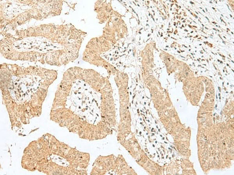 Immunohistochemistry of paraffin-embedded Human liver cancer tissue using BEX2 Polyclonal Antibody at dilution of 1:50(×200)