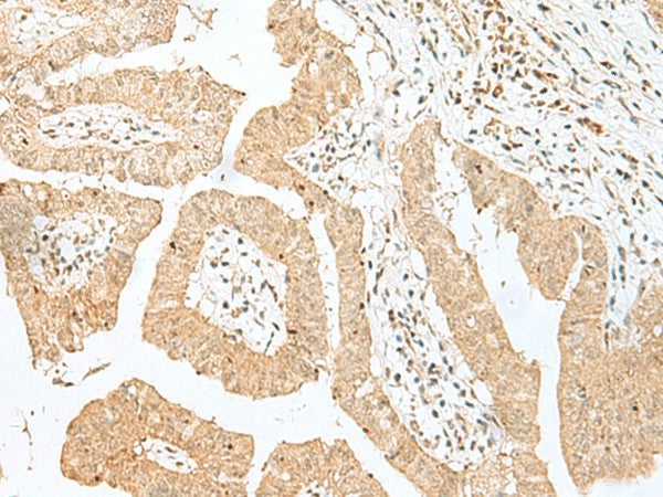 Immunohistochemistry of paraffin-embedded Human liver cancer tissue using BEX2 Polyclonal Antibody at dilution of 1:50(×200)