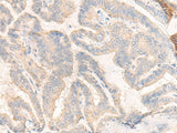 Immunohistochemistry of paraffin-embedded Human thyroid cancer tissue using COG4 Polyclonal Antibody at dilution of 1:30(×200)