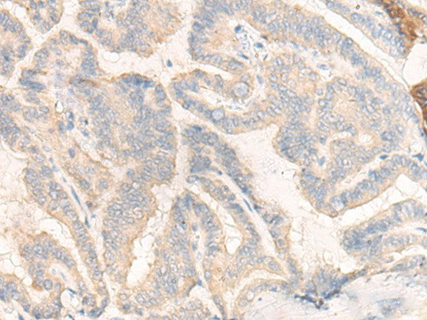 Immunohistochemistry of paraffin-embedded Human thyroid cancer tissue using COG4 Polyclonal Antibody at dilution of 1:30(×200)