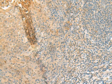 Immunohistochemistry of paraffin-embedded Human tonsil tissue using GPT2 Polyclonal Antibody at dilution of 1:70(×200)