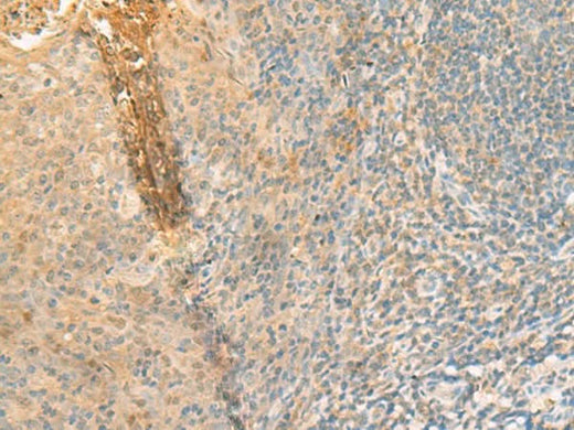 Immunohistochemistry of paraffin-embedded Human tonsil tissue using GPT2 Polyclonal Antibody at dilution of 1:70(×200)