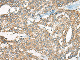 Immunohistochemistry of paraffin-embedded Human liver cancer tissue using YEATS2 Polyclonal Antibody at dilution of 1:55(×200)