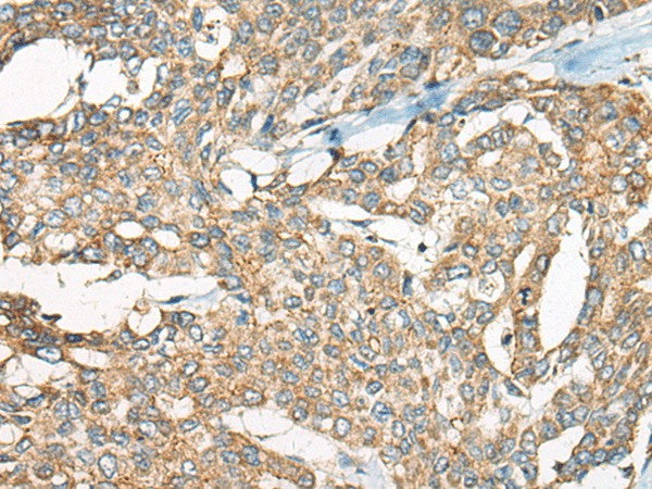 Immunohistochemistry of paraffin-embedded Human liver cancer tissue using YEATS2 Polyclonal Antibody at dilution of 1:55(×200)