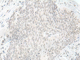Immunohistochemistry of paraffin-embedded Human esophagus cancer tissue using ORC1 Polyclonal Antibody at dilution of 1:65(×200)