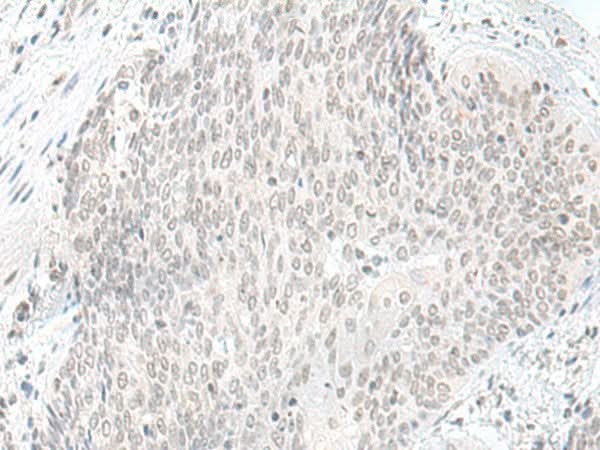Immunohistochemistry of paraffin-embedded Human esophagus cancer tissue using ORC1 Polyclonal Antibody at dilution of 1:65(×200)