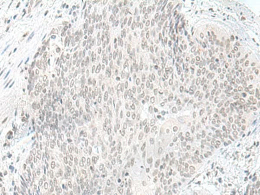 Immunohistochemistry of paraffin-embedded Human esophagus cancer tissue using ORC1 Polyclonal Antibody at dilution of 1:65(×200)