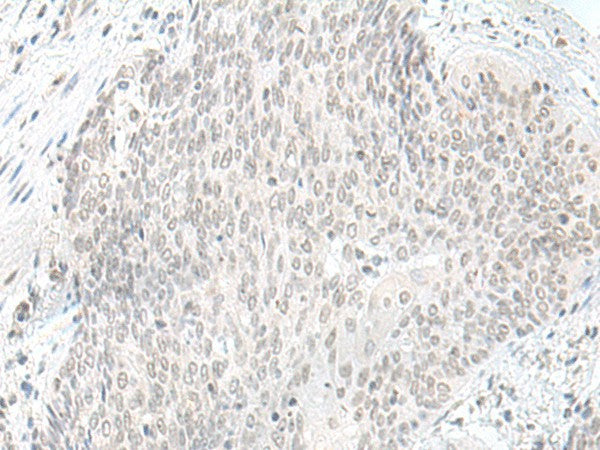 Immunohistochemistry of paraffin-embedded Human esophagus cancer tissue using ORC1 Polyclonal Antibody at dilution of 1:65(×200)