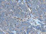 Immunohistochemistry of paraffin-embedded Human thyroid cancer tissue using SLC24A5 Polyclonal Antibody at dilution of 1:50(×200)