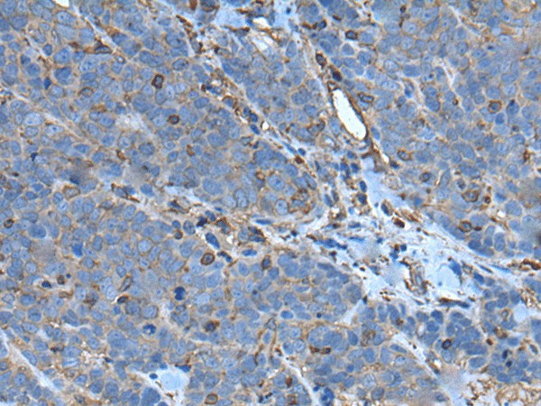 Immunohistochemistry of paraffin-embedded Human thyroid cancer tissue using SLC24A5 Polyclonal Antibody at dilution of 1:50(×200)