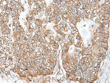 Immunohistochemistry of paraffin-embedded Human gastric cancer tissue using RNF111 Polyclonal Antibody at dilution of 1:50(×200)