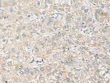 Immunohistochemistry of paraffin-embedded Human liver cancer tissue using RAC2 Polyclonal Antibody at dilution of 1:60(×200)
