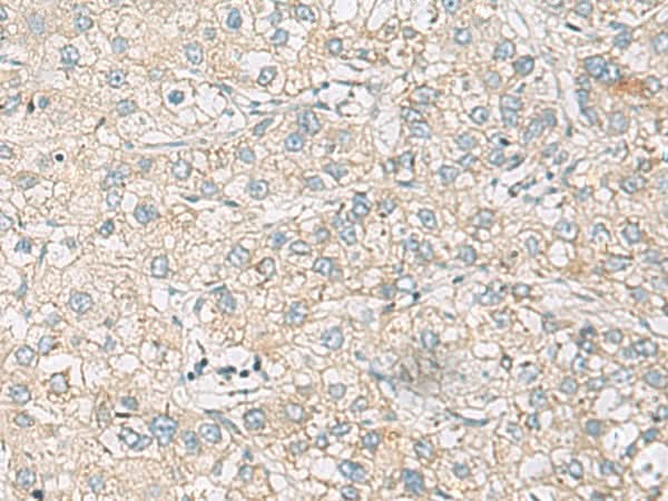 Immunohistochemistry of paraffin-embedded Human liver cancer tissue using RAC2 Polyclonal Antibody at dilution of 1:60(×200)