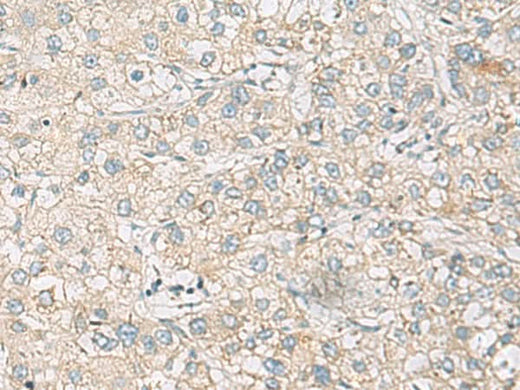Immunohistochemistry of paraffin-embedded Human liver cancer tissue using RAC2 Polyclonal Antibody at dilution of 1:60(×200)
