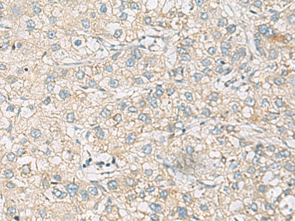 Immunohistochemistry of paraffin-embedded Human liver cancer tissue using RAC2 Polyclonal Antibody at dilution of 1:60(×200)