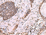 Immunohistochemistry of paraffin-embedded Human esophagus cancer tissue using NASP Polyclonal Antibody at dilution of 1:60(×200)