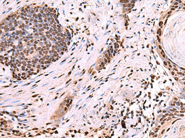 Immunohistochemistry of paraffin-embedded Human esophagus cancer tissue using NASP Polyclonal Antibody at dilution of 1:60(×200)